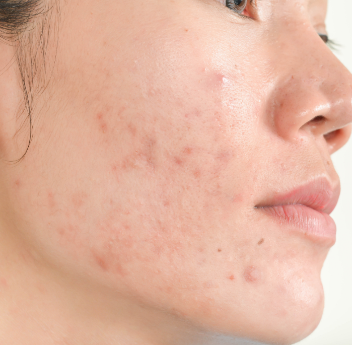 Acne Prone Skin