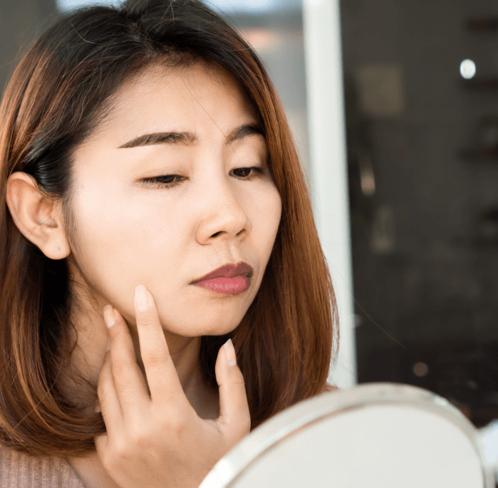 What Is The Best Natural Treatment for Melasma