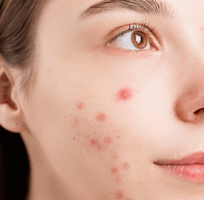 Fade Acne Scars and Blemishes The Old Fashioned Way!