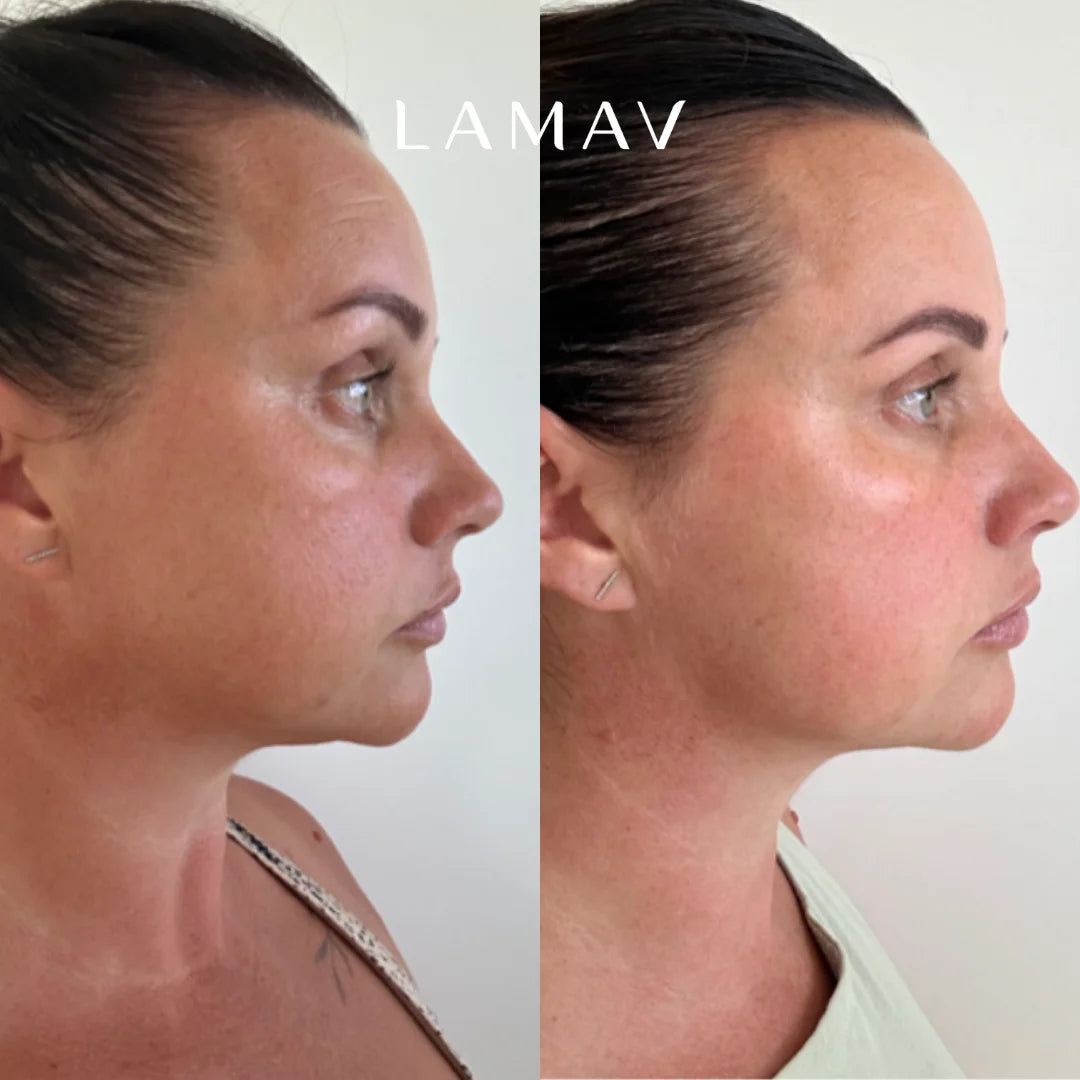 Before and after using the LAMAV Ayurvedic Kansa Wand facial massage tool, showing a lifted, refreshed-looking face