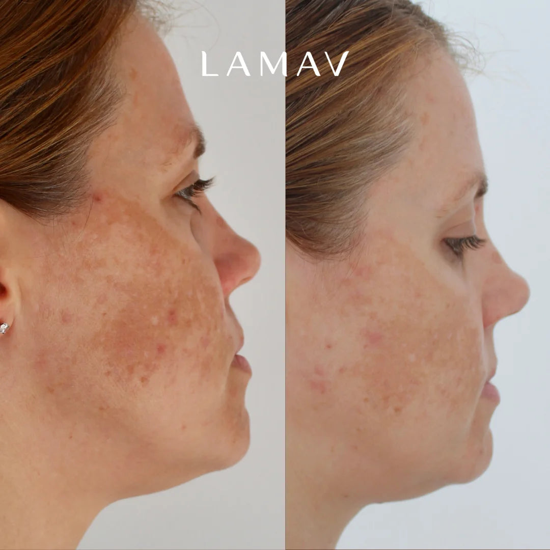 Before and after using LAMAV Brightening Organic Skincare Essentials, showing a brighter, more even-looking skin tone