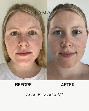 Acne Essential Kit by LAMAV — woman's before and after face comparison | Clears breakouts and redness