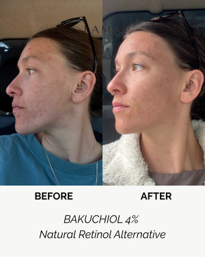 Bakuchiol 4% Booster by LAMAV — before and after split screen of side profile | reduces redness and clears skin