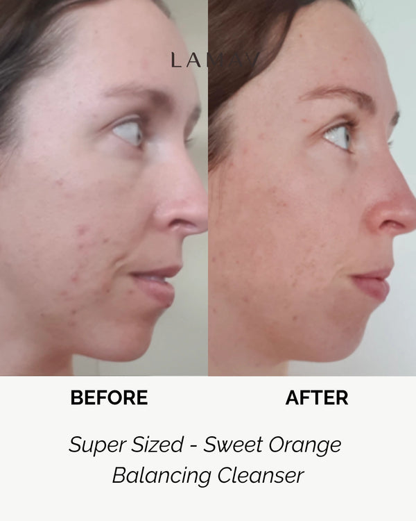 Super Sized Sweet Orange Balancing Cleanser by LAMAV — woman's before and after side profile | naturally clears blemishes