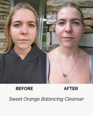 Sweet Orange Balancing Cleanser by LAMAV — woman's front face before and after | balances skin and clears blemishes