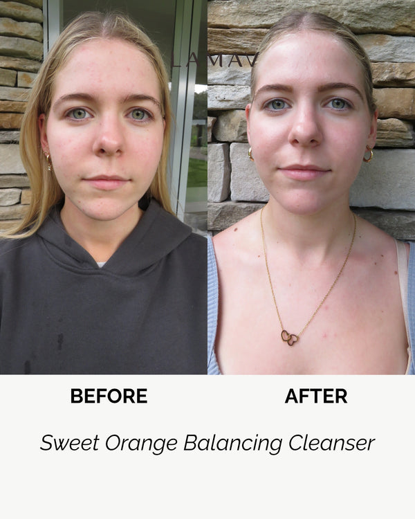 Sweet Orange Balancing Cleanser by LAMAV — woman's front face before and after | balances skin and clears blemishes