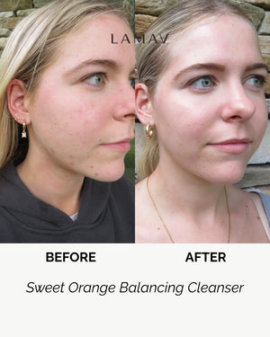 Sweet Orange Balancing Cleanser by LAMAV — woman's side profile before and after | visibly reduces acne and breakouts
