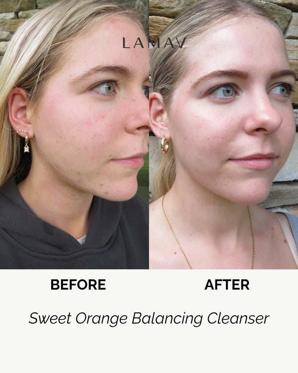 Sweet Orange Balancing Cleanser by LAMAV — woman's side profile before and after | visibly reduces acne and breakouts