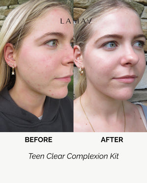 Teen Clear Complexion Kit by LAMAV — teen girl before and after photos | visibly reduced acne and redness