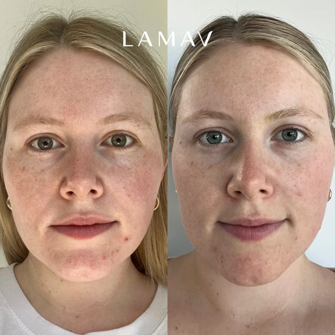 Before and after using the LAMAV Acne Essential Kit, showing calmer, clearer-looking skin with less visible redness